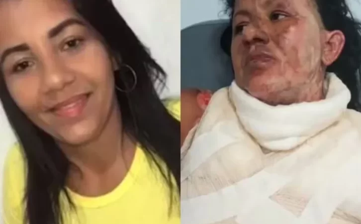 Mulher que teve 70% do corpo queimado morre após 2